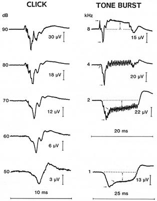 Tone Burst Electrocochleography for the Diagnosis of Clinically Certain Meniere's Disease